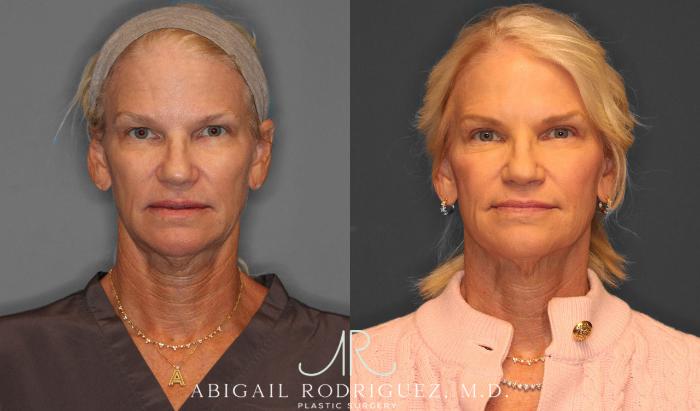 Before & After Upper Eyelid Lift Case 258570 View 1 View in Houston, TX