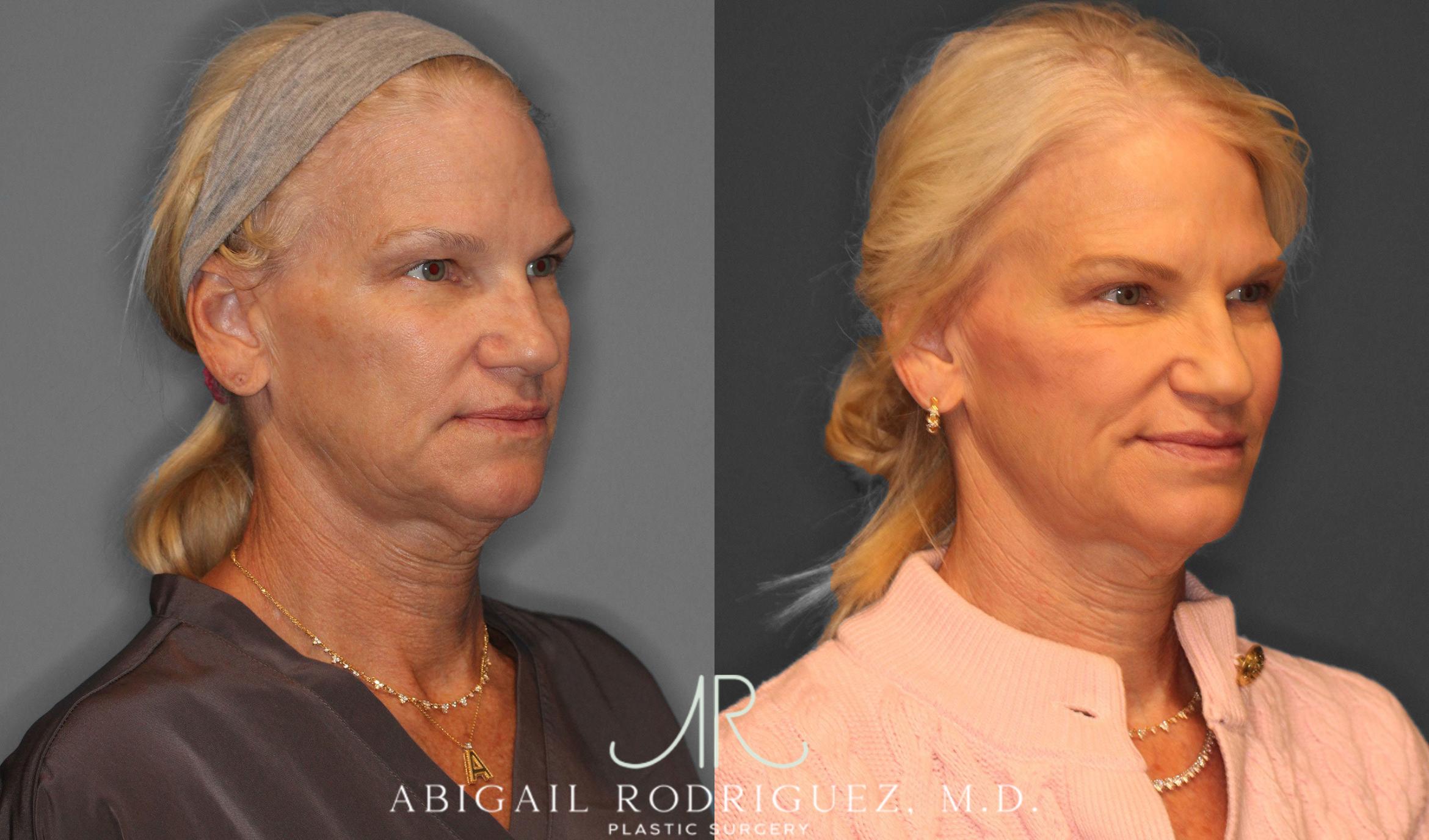 Before & After Upper Eyelid Lift Case 258570 View 2 View in Houston, TX