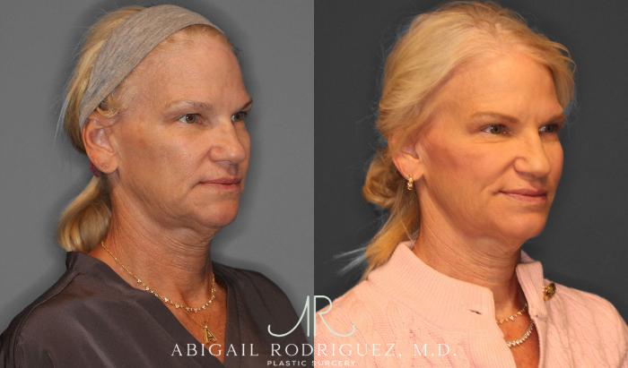 Before & After Upper Eyelid Lift Case 258570 View 2 View in Houston, TX