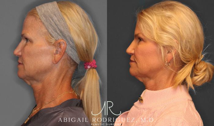 Before & After Upper Eyelid Lift Case 258570 View 3 View in Houston, TX