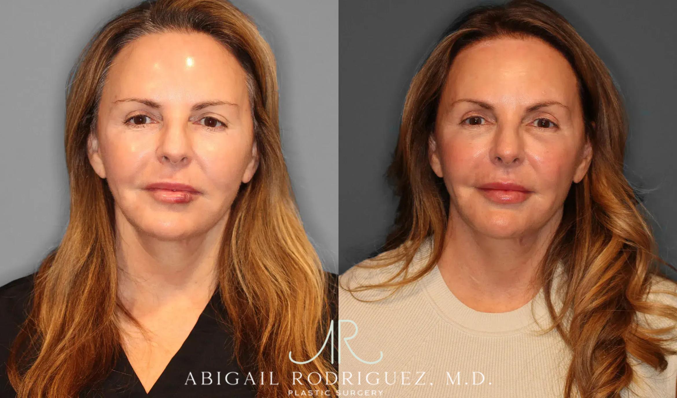 Before & After Upper Eyelid Lift Case 259058 View 1 View in Houston, TX