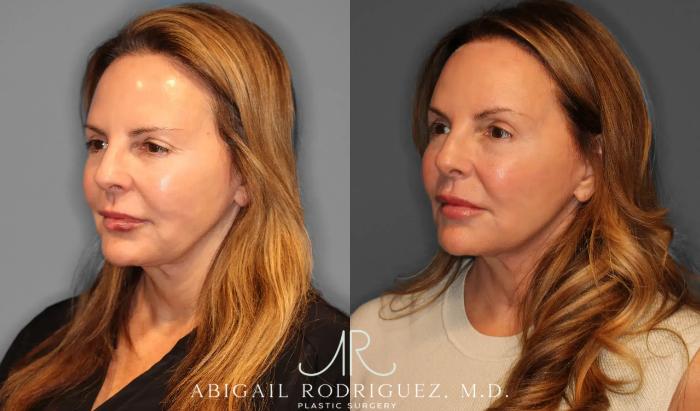 Before & After Upper Eyelid Lift Case 259058 View 2 View in Houston, TX
