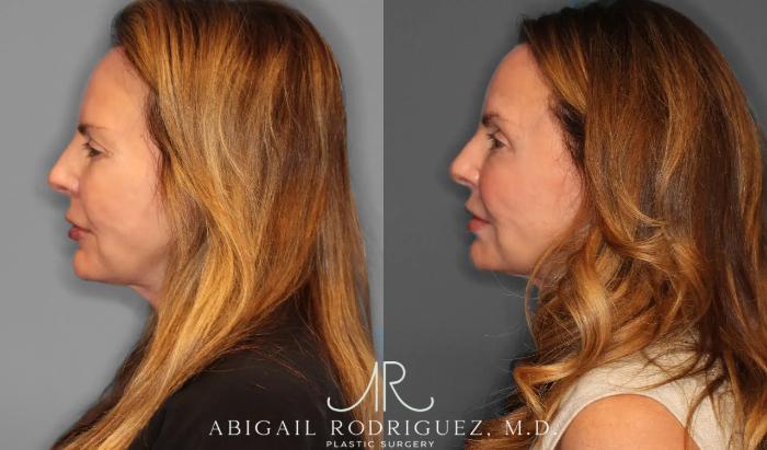 Before & After Upper Eyelid Lift Case 259058 View 3 View in Houston, TX