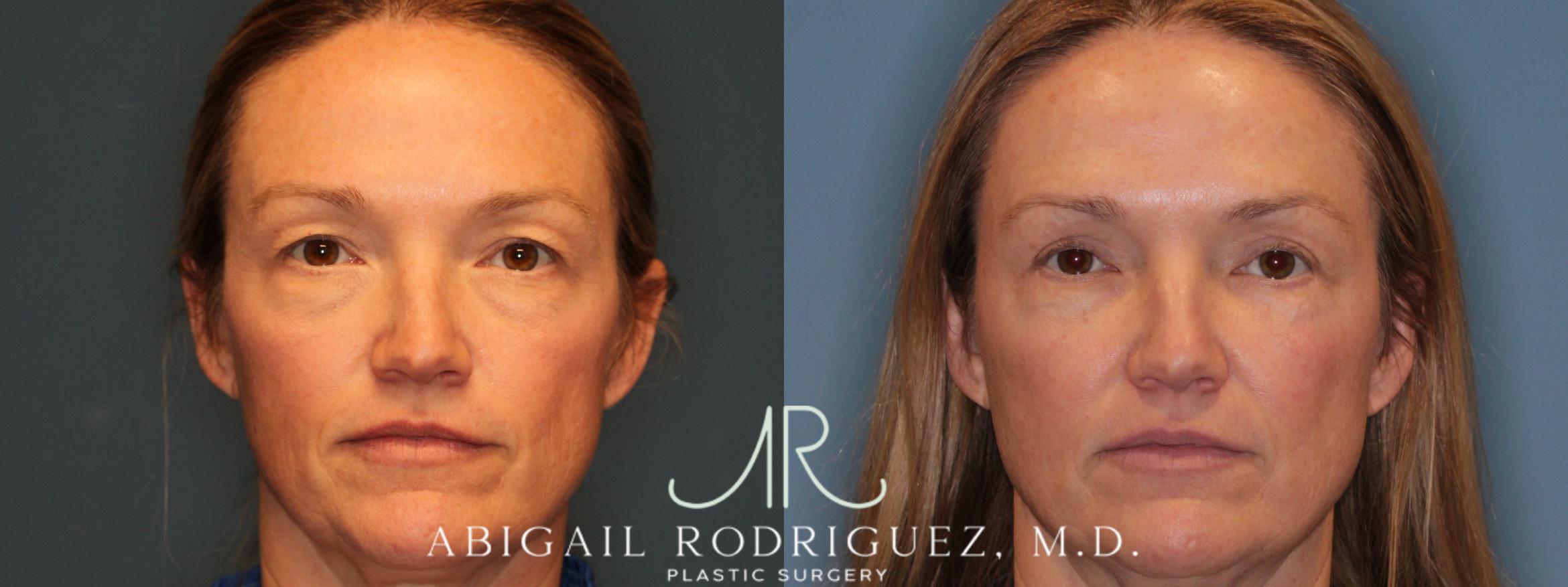 Before & After Upper Eyelid Lift Case 346004 Front View in Houston, TX