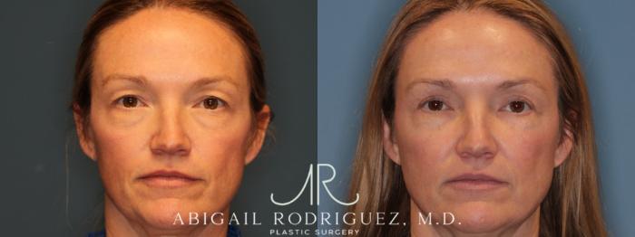 Before & After Upper Eyelid Lift Case 346004 Front View in Houston, TX