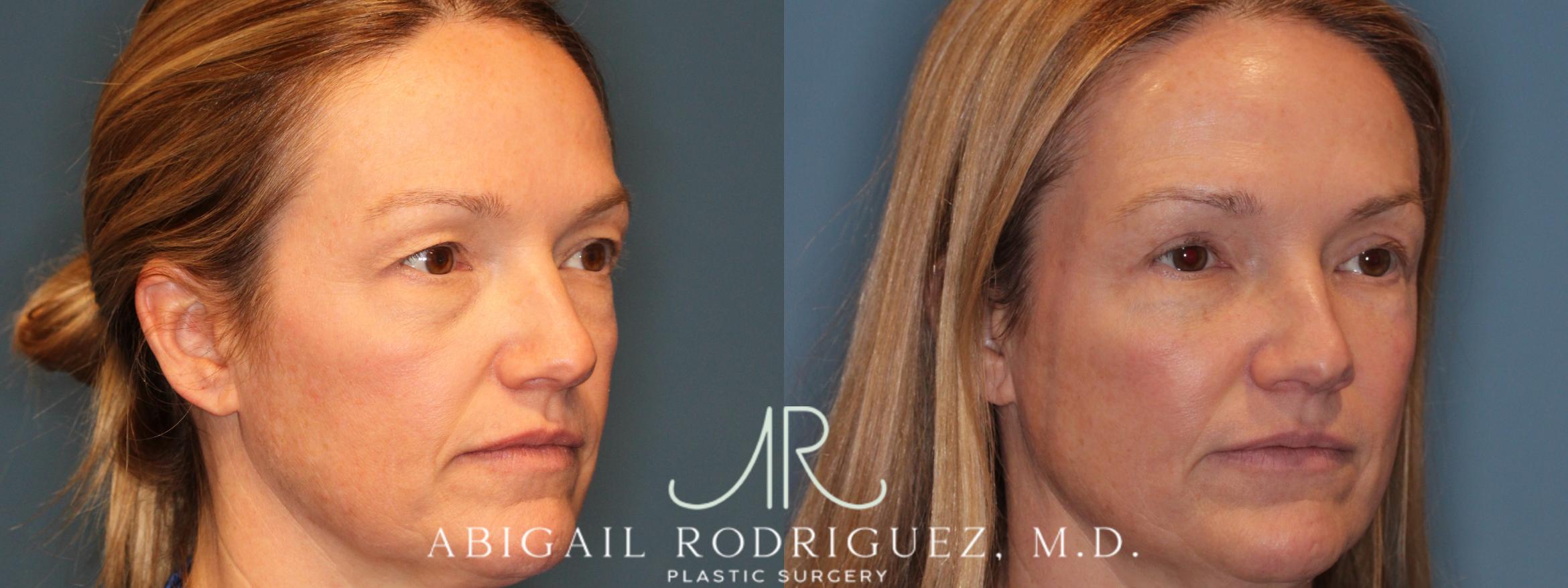 Before & After Upper Eyelid Lift Case 346004 Left Oblique View in Houston, TX