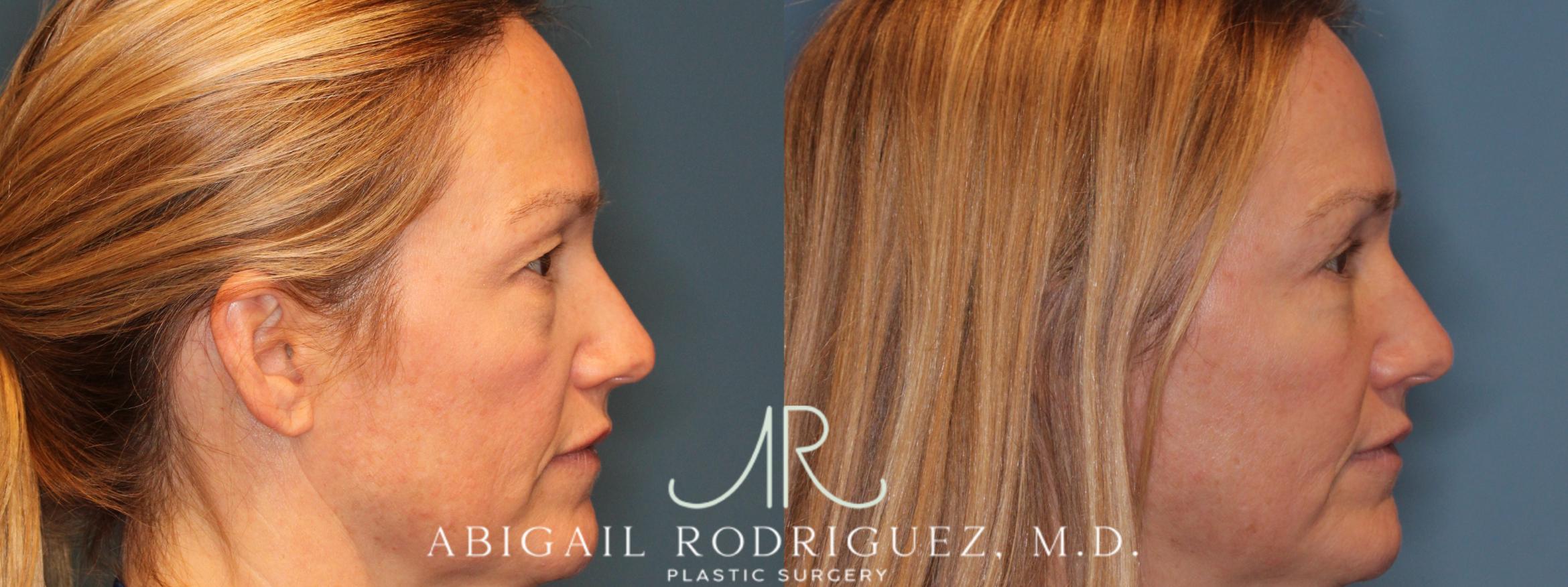 Before & After Upper Eyelid Lift Case 346004 Left Side View in Houston, TX