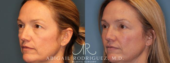 Before & After Upper Eyelid Lift Case 346004 Right Oblique View in Houston, TX