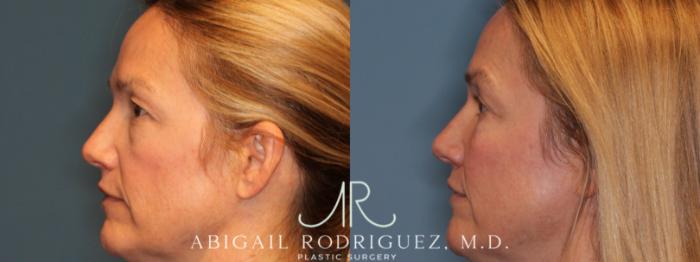 Before & After Upper Eyelid Lift Case 346004 Right Side View in Houston, TX